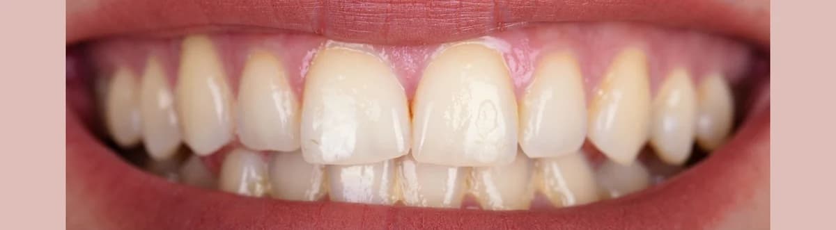 Clareamento Dental - Antes