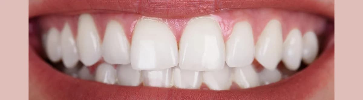 Clareamento Dental - Depois