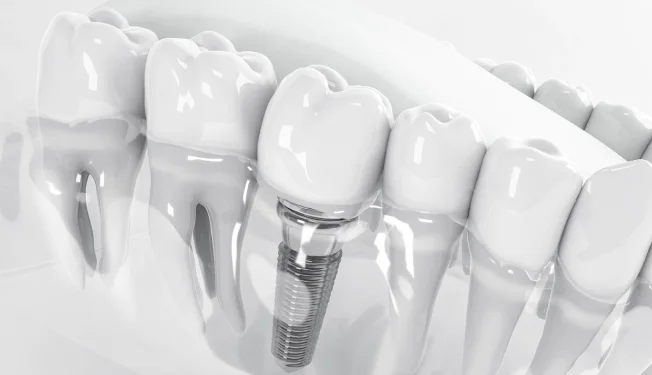 Prótese e Implantes