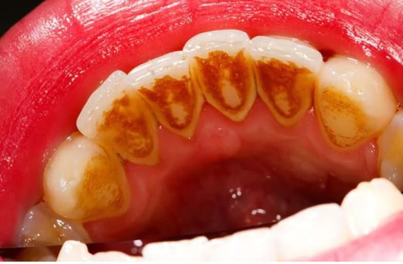 Tratamento de Gengiva (Periodontia) - Antes