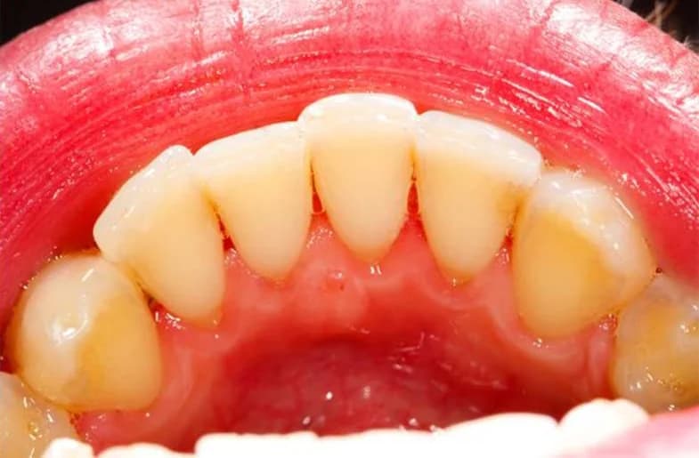 Tratamento de Gengiva (Periodontia) - Depois