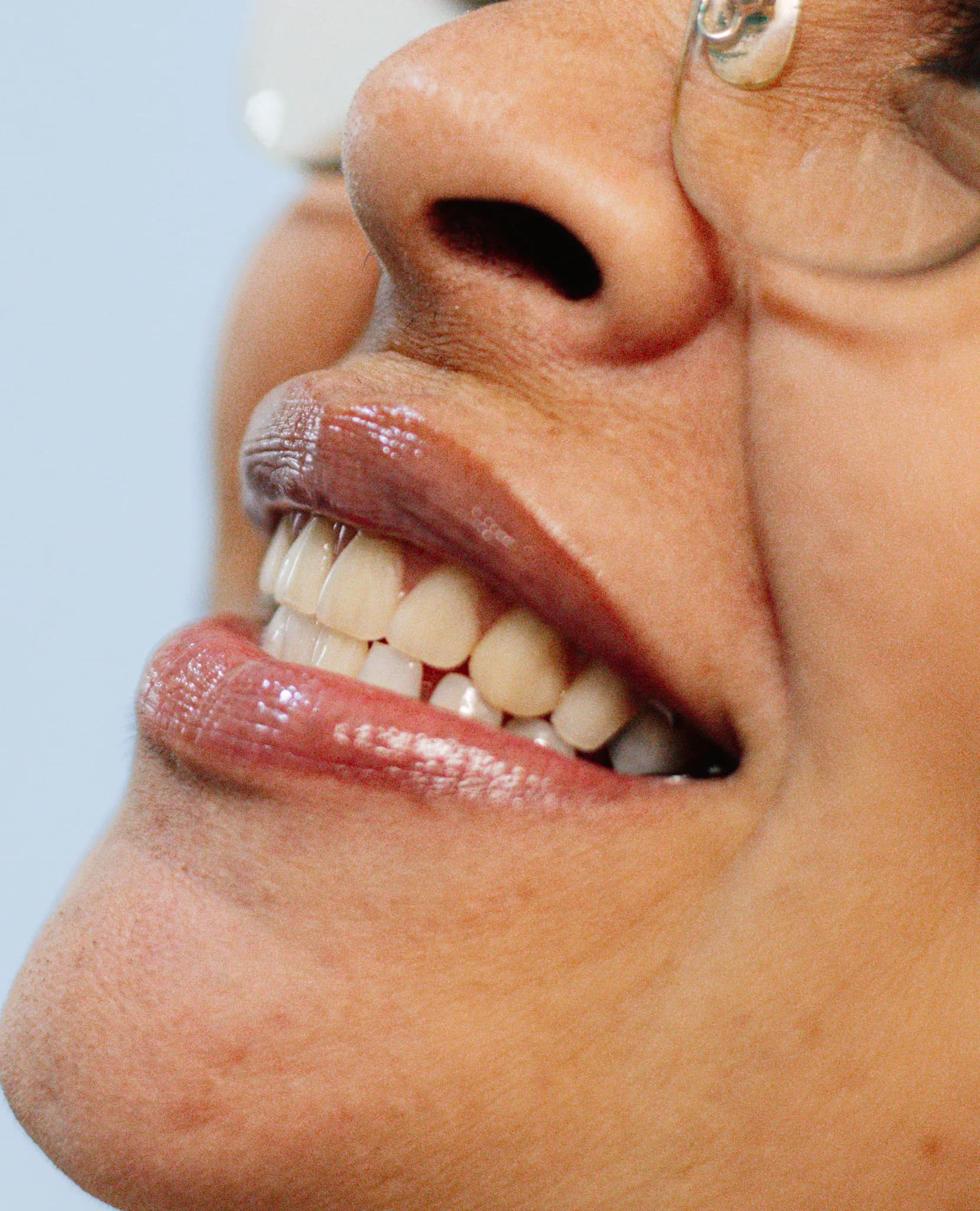 Implantes Dentários - Depois